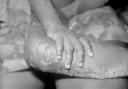 A file photo of a monkeypox rash. Picture: Alamy/PA