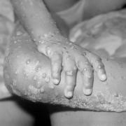 A file photo of a monkeypox rash. Picture: Alamy/PA