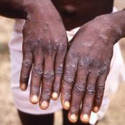 Mpox causes flu-like symptoms, skin lesions and can be fatal