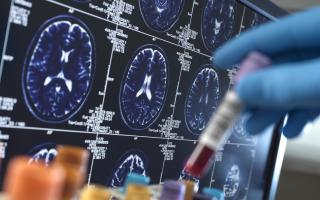 Alzheimer's and Dementia Research, Scientist holding a blood sample during a clinical trial